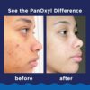 PanOxyl Acne Foaming Wash Benzoyl Peroxide 10% Maximum Strength Antimicrobial, 5.5 Oz - Image 6